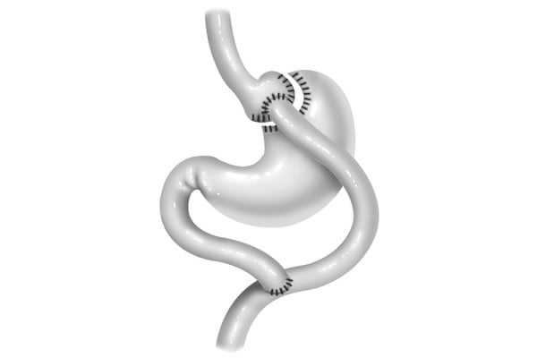 Diagram of a gastric bypass