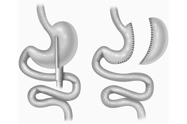 Diagram of a vertical sleeve gastrectomy