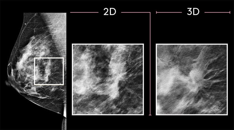 3D Mammography screening images