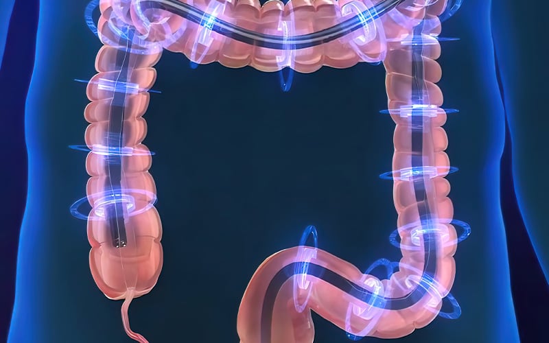 Illustration of a colonoscopy