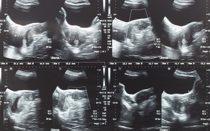 Ultrasound images for gynecologic cancer screening