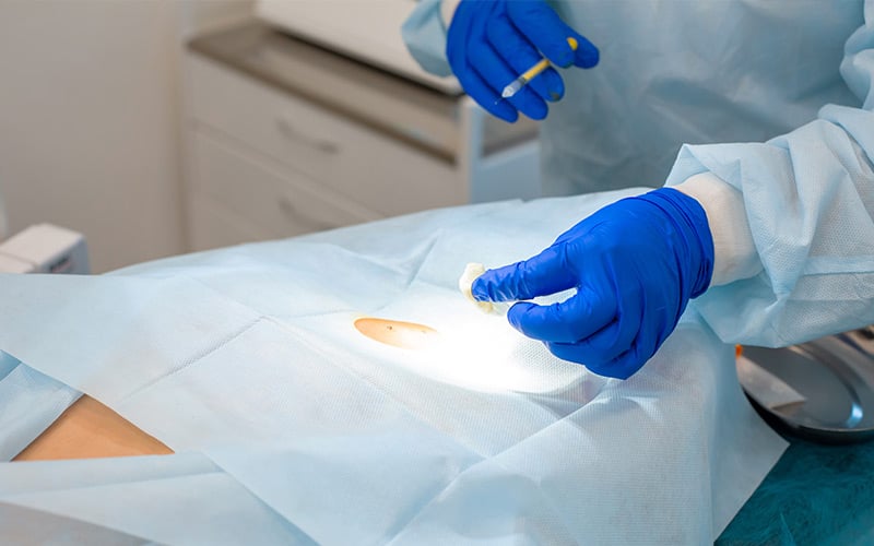 A surgeon preparing a location on skin for Mohs surgery
